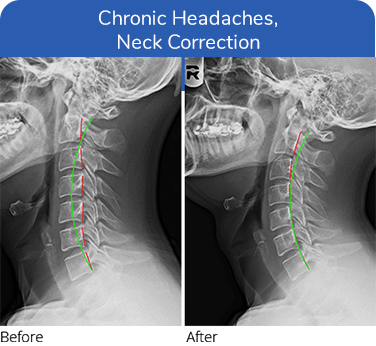 Chiropractic Plano TX Chronic Headaches