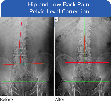 Chiropractic Plano TX Low Back Hip Pain