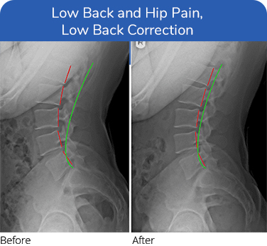 Chiropractic Plano TX Low Back Hip