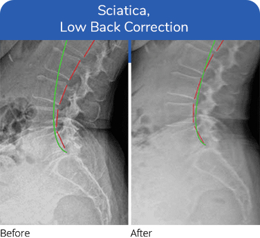 Chiropractic Plano TX Sciatica