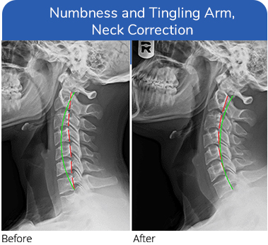 Chiropractic Plano TX Tingling Arm