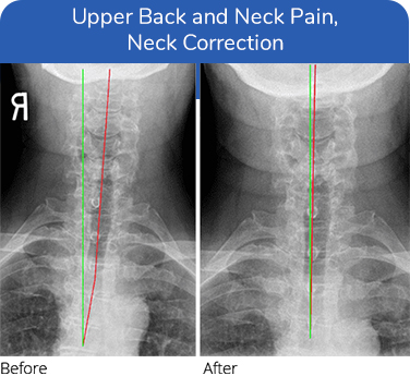 Chiropractic Plano TX Upper Back and Neck